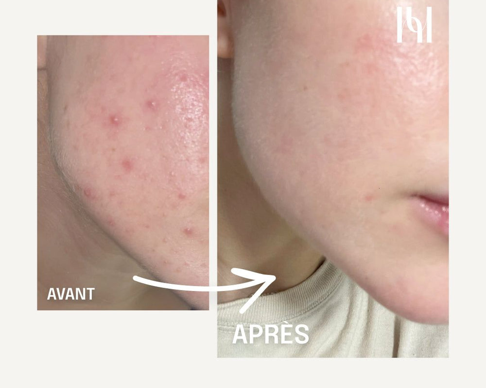 HOLITE: Complément Alimentaire Liquide Visage Peau nette